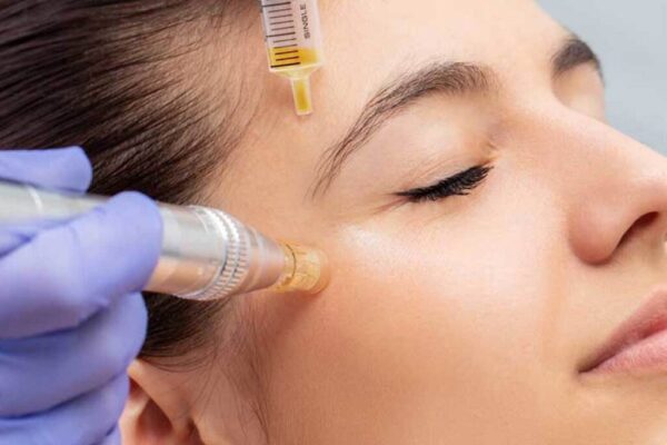 PRP + MICRONEEDLING